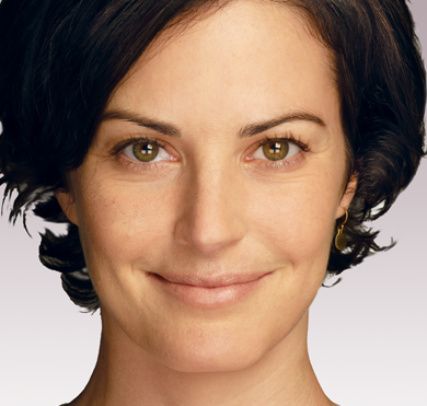 Jill - After Juvéderm®