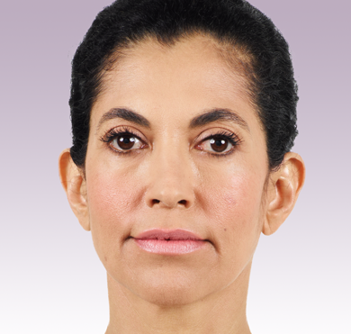 Lizette - Before Juvéderm®